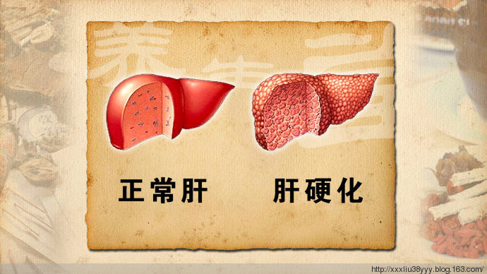 肝硬化的症状有哪些