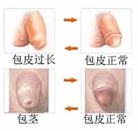 及时认清包茎