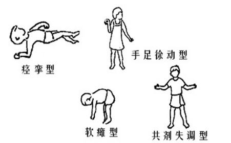 小儿脑瘫的治疗方法都有哪些