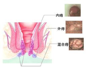 痔疮原因有哪些?