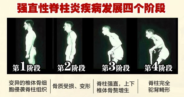 4大病因造成强直性脊柱炎，您知几个？
