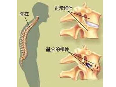 强直性脊柱炎的主要危害有哪些