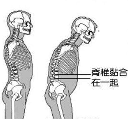强直性脊柱炎一般是哪些病因导致的？