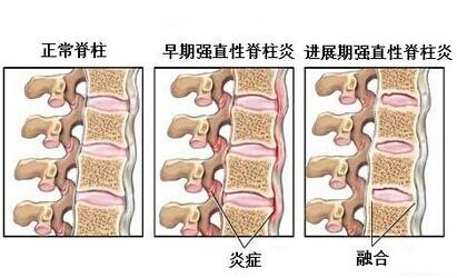 晨起腰背僵痛需警惕强直性脊柱炎
