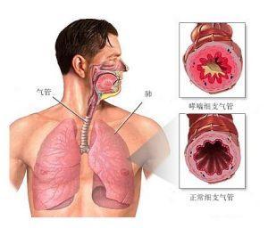 哮喘的病因是什么