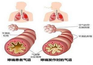 哮喘的治疗意义