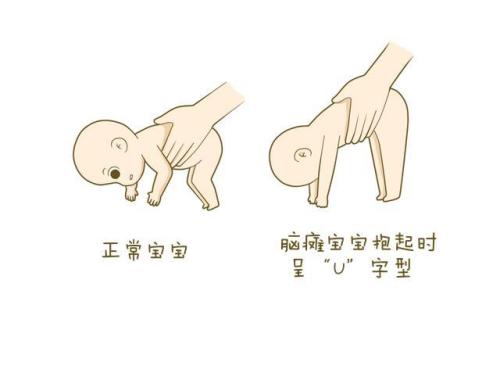脑瘫的发病原因是什么？