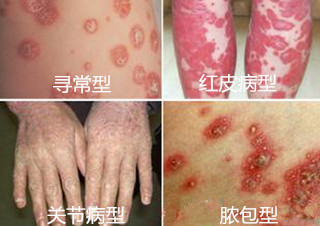中医超导活化疗法 专业快速治牛皮廯不复发