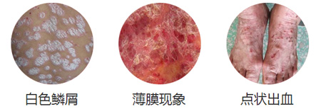 【危害】牛皮癣的危害有哪些