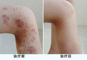 【原因】牛皮癣的发病和什么有关系