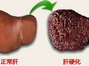 造成肝硬化的病因分析 肝区隐痛要当心