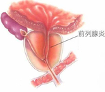 5大检查确诊急性前列腺炎 科学治疗前“腺”危机