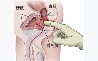 尿频、尿急警惕前列腺炎 及时诊治防癌变