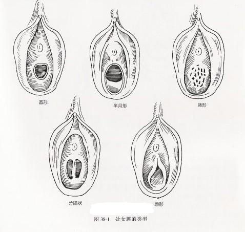 做阴茎延长手术有用么?