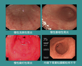 慢性胃炎的症状表现