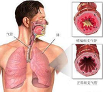 支气管炎会致命吗