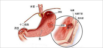 预防胃溃疡的五种方法