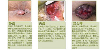 外痔如何治疗？
