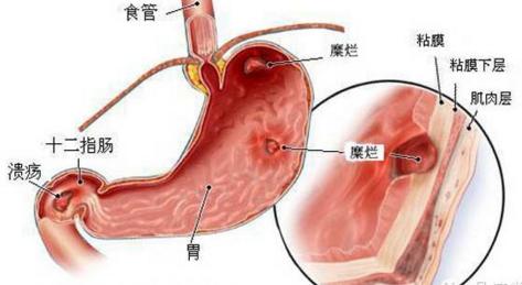 慢性胃炎要注意什么及保养措施