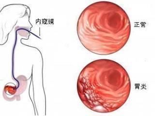 慢性胃炎挂什么科
