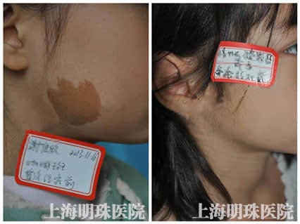 脸上长咖啡斑的原因是什么