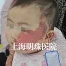 怎样有效祛红胎记？