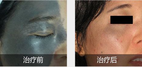 青胎记反复复发怎么办？